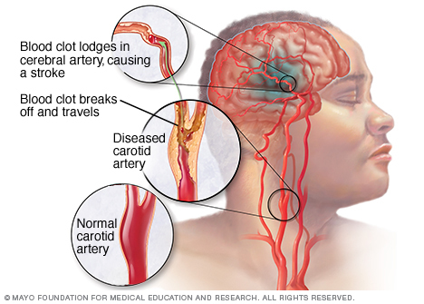 r7_ischemicstroke.jpg