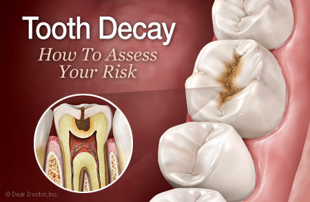 tooth-decay-risk-450.jpg