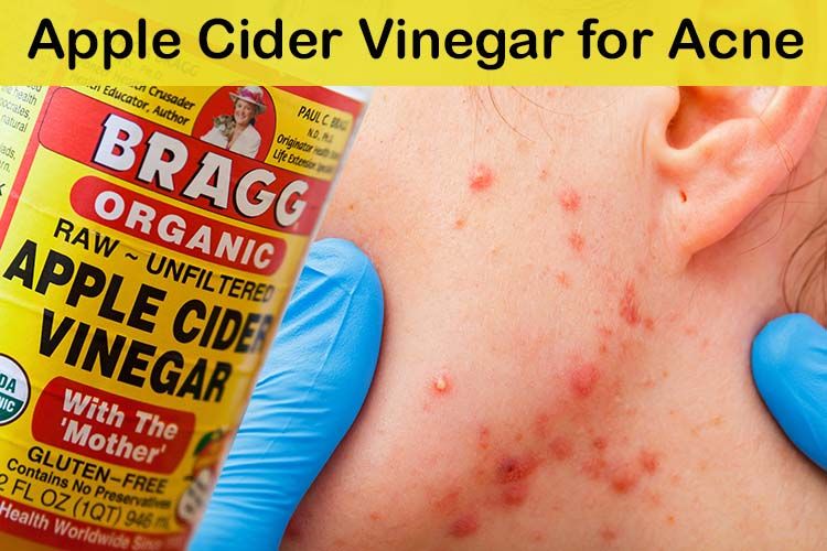 Apple-Cider-Vinegar-for-Acne-1.jpg