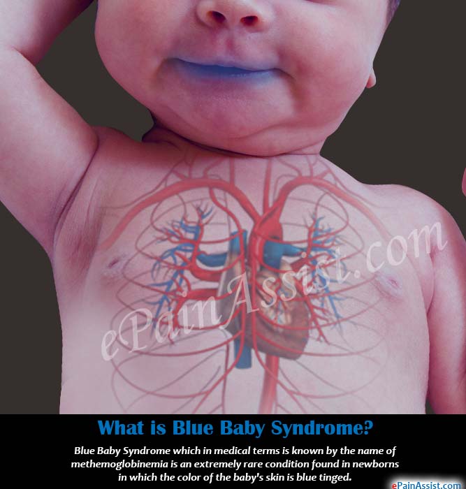 what-blue-baby-syndrome.jpg