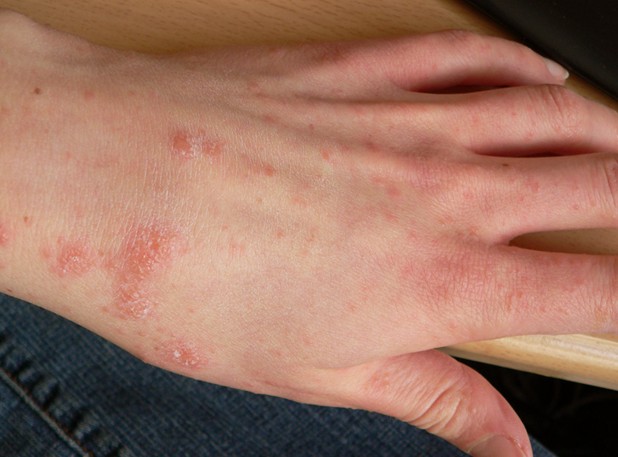 scabies-facts-remedies.jpg