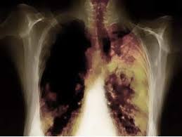 Lung cancer.jpg