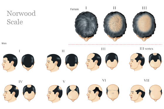 hair-loss-men.jpg