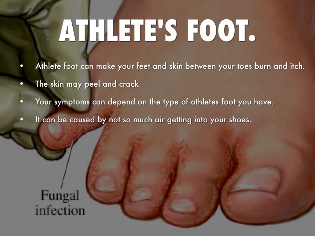 fungus from clean shoes a Diseases On â€“ Mission Educate: Childhood Ringworm to