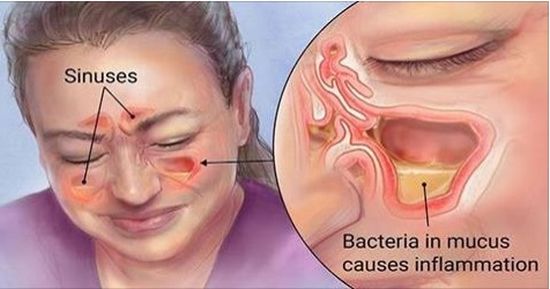 severe sinus infection