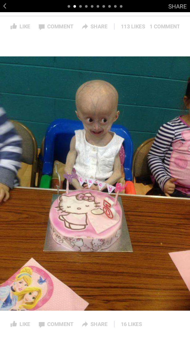 The Rare Disease Progeria Steemit