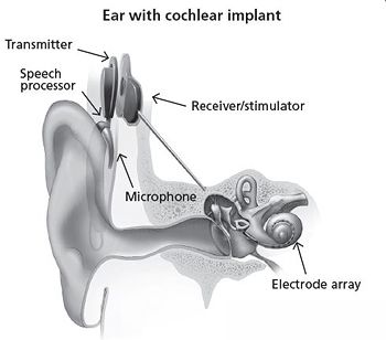 cochlear-implant-web-pic.jpg