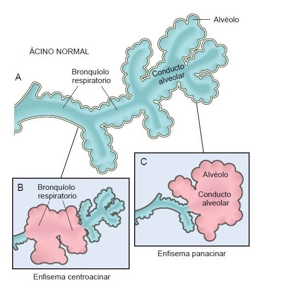 fisiopatología del enfisema