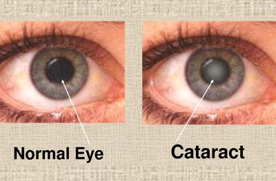 cataract.jpg