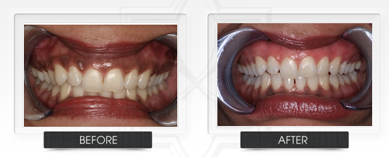 Gums Turning Black
