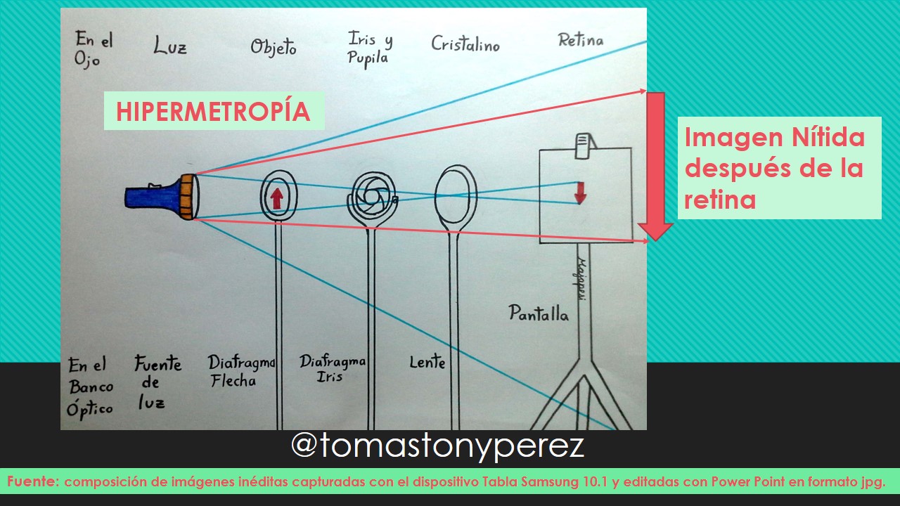 HIPERMETROPIA.jpg