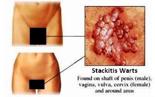 Blue-Waffles-Disease-Image.jpg