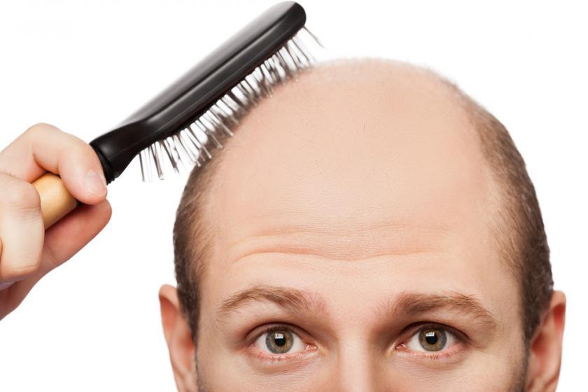 male-pattern-baldness.jpg