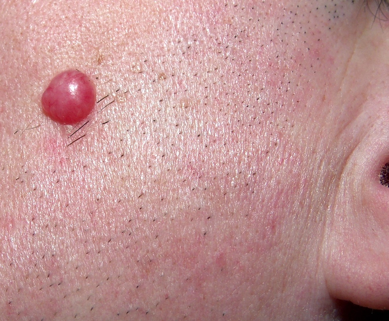 Borrelial_lymphocytoma.jpg