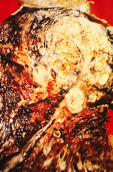220px-Cancerous_lung.jpg