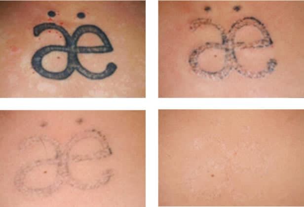 tattoo-removal-healing-process.jpg