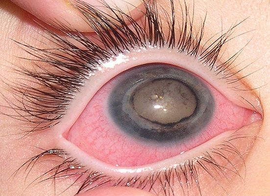 Eye_of_patient_with_Coats'_disease.jpg