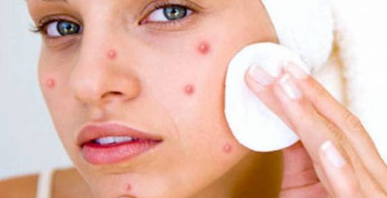 Who-to-Get-Rid-Of-Pimples.jpg