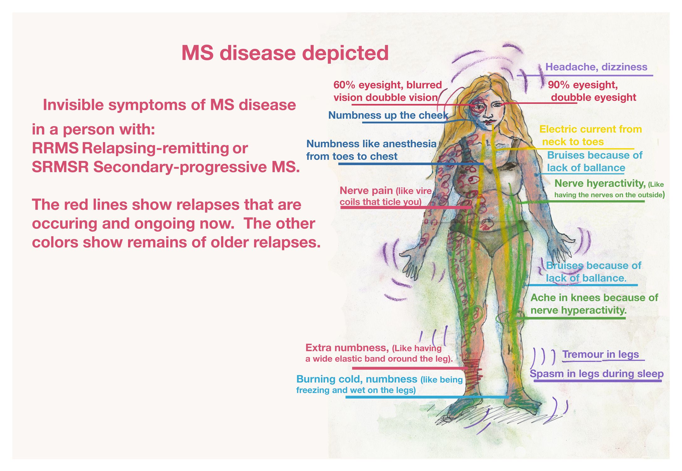 ms einkenni i mali og myndum enska flatt.jpg