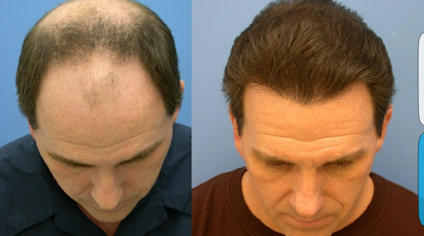 Мужчина после ковида. Трансплантация волос до и после. Пересадка волос волос до и после. До и после пересадки волос мужчинам.