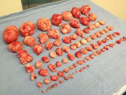 90-fibroids-removed,-cred-Michael-D.jpg