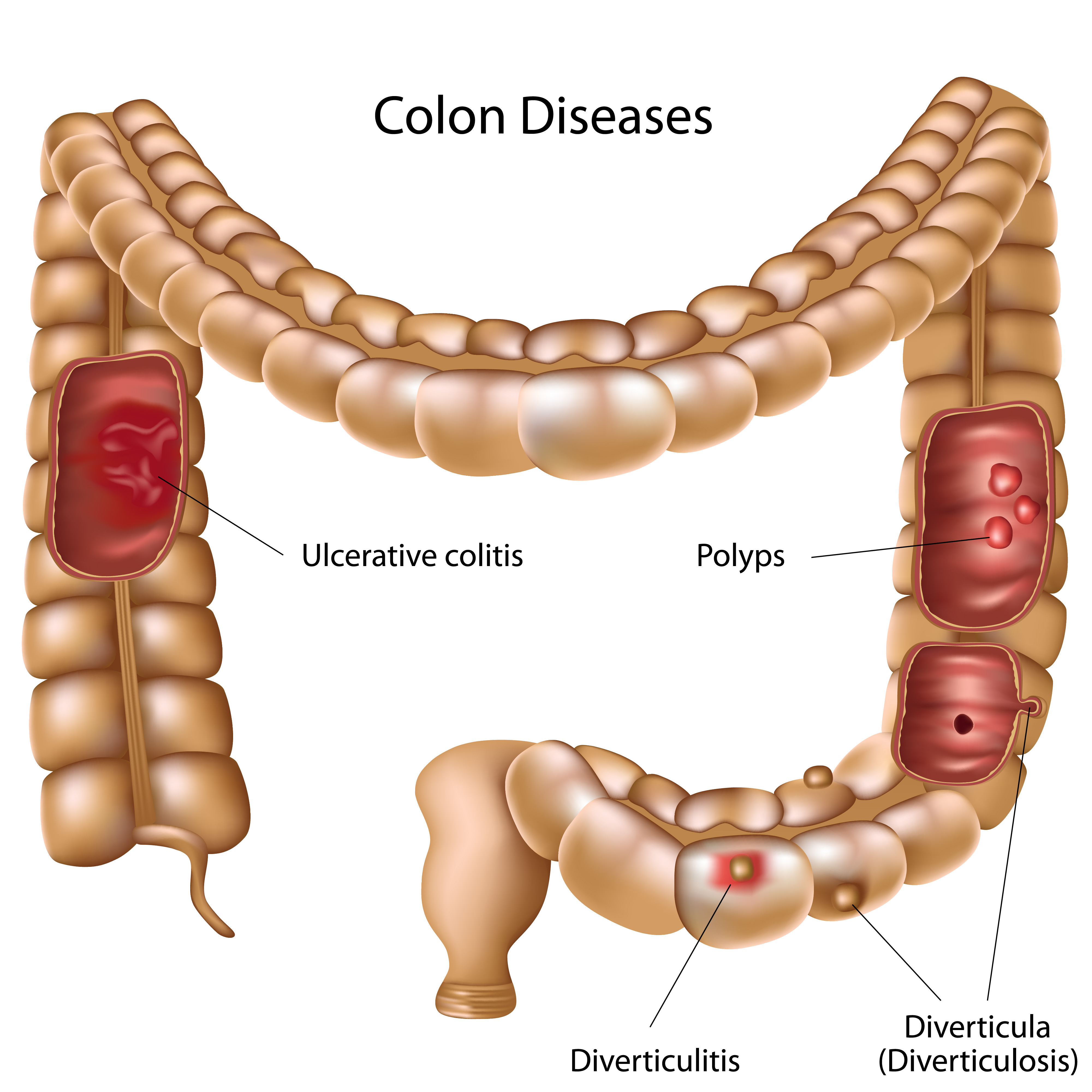 Fundamentals Of Ulcerative Colitis: Symptoms & Treatments