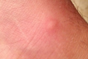 640-mosquito-bite-300x201.jpg