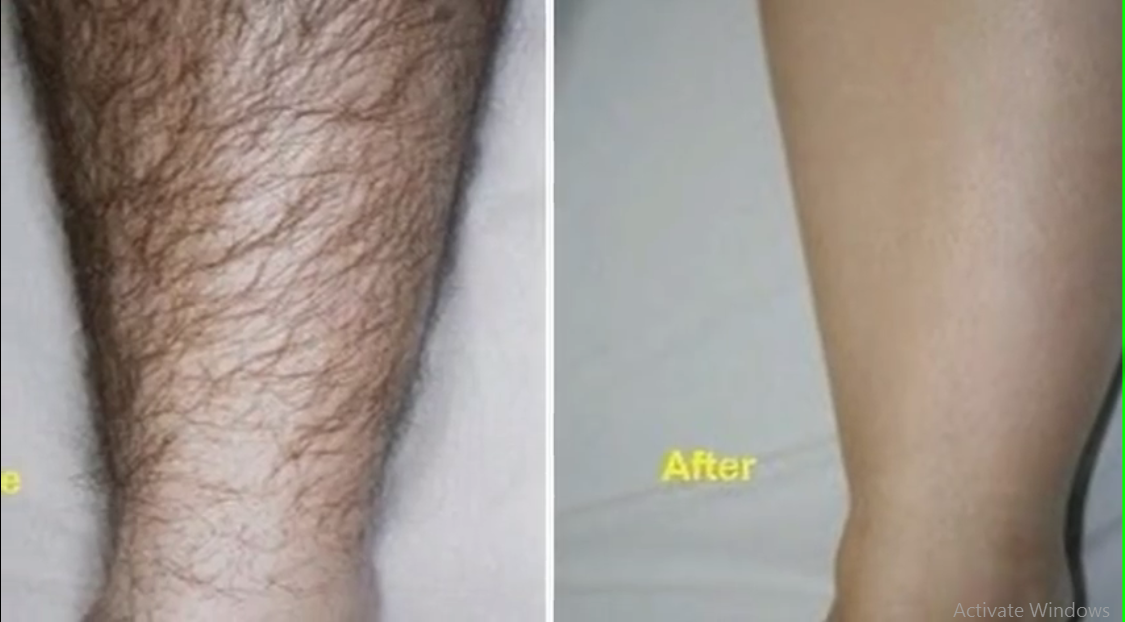 How To Remove Unwanted Hair With Toothpaste Lemon Juice Sugar