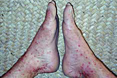 DengueFeetMar02decN119.jpg