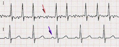 Afib_ecg.jpg