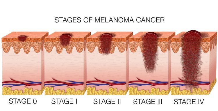 melanoma-skin-cancer-stages.jpg