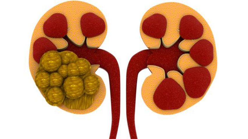 Kidney stones.jpg