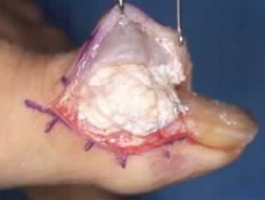 gout-surgery.jpg