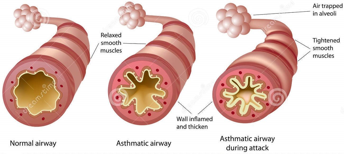 asthmanew.jpg