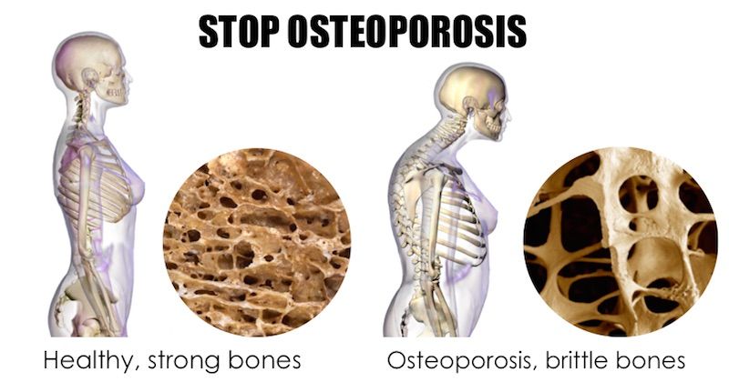 stop-osteoporosis.jpg