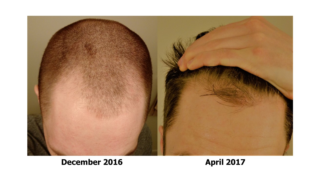 Using Minoxidil to Regrow Hair — Steemit