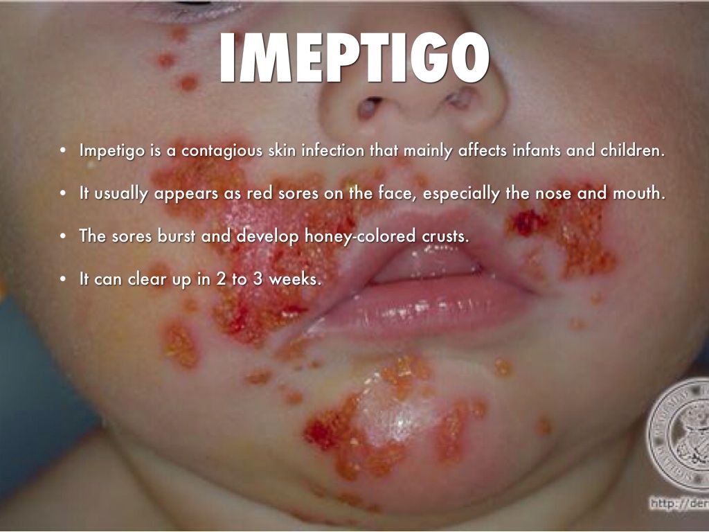 Teachers & Parents Beware of Impetigo: I Gave It To My Teacher — Steemit