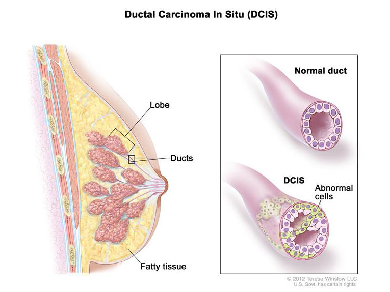 ductal-carcinoma-in-situ-enlarge.__v20067462.jpg