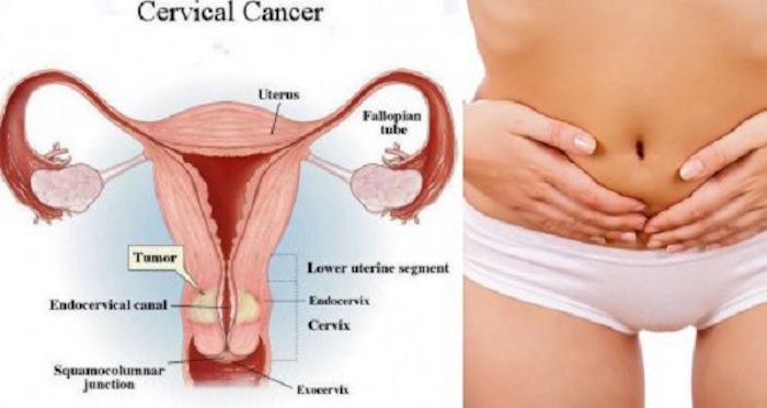 3 Signs of Cervical Cancer of The Uterus That Can Not be Ignored.jpg