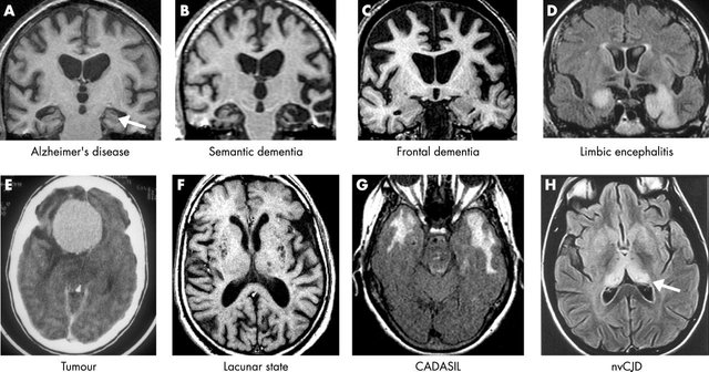 Мрт мозга ногинск. Болезнь Альцгеймера мрт. Болезнь Альцгеймера на кт головного мозга. Мрт в диагностике болезни Альцгеймера. Мрт головного мозга при болезни Альцгеймера.