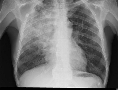 pneumonia.jpg