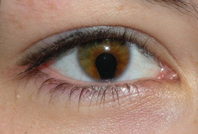 Coloboma_of_the_iris.jpg
