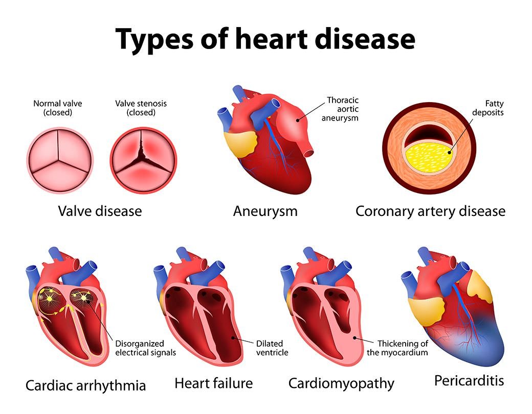 Heart disease