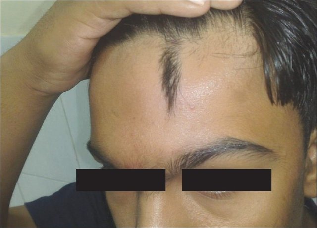 Гипертрихоз вырастание волос на краю ушной раковины наследуется как признак
