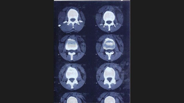 MRI Spine 1.jpg