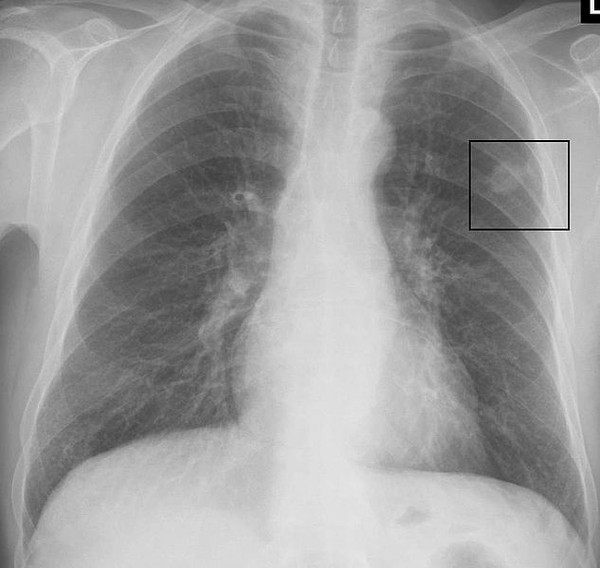 633px-Thorax_pa_peripheres_Bronchialcarcinom_li_OF_markiert.jpg