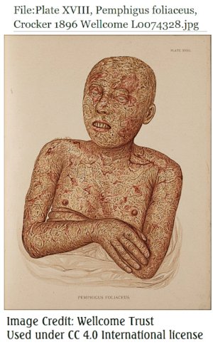 Pemphigus foliaceus, Crocker2 1896 Wellcome L0074328 CC 4.0 Wellcome Trust.jpg