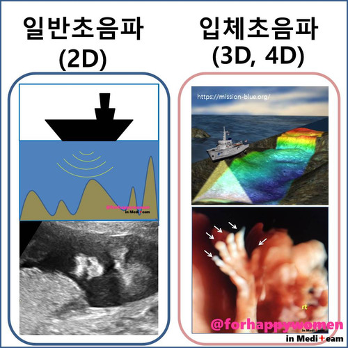 일반초음파VS입체초음파.jpg