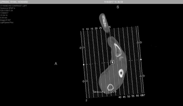 hand ct 3.jpg