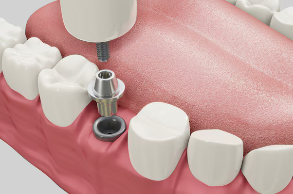 dental implants huntsville al.png